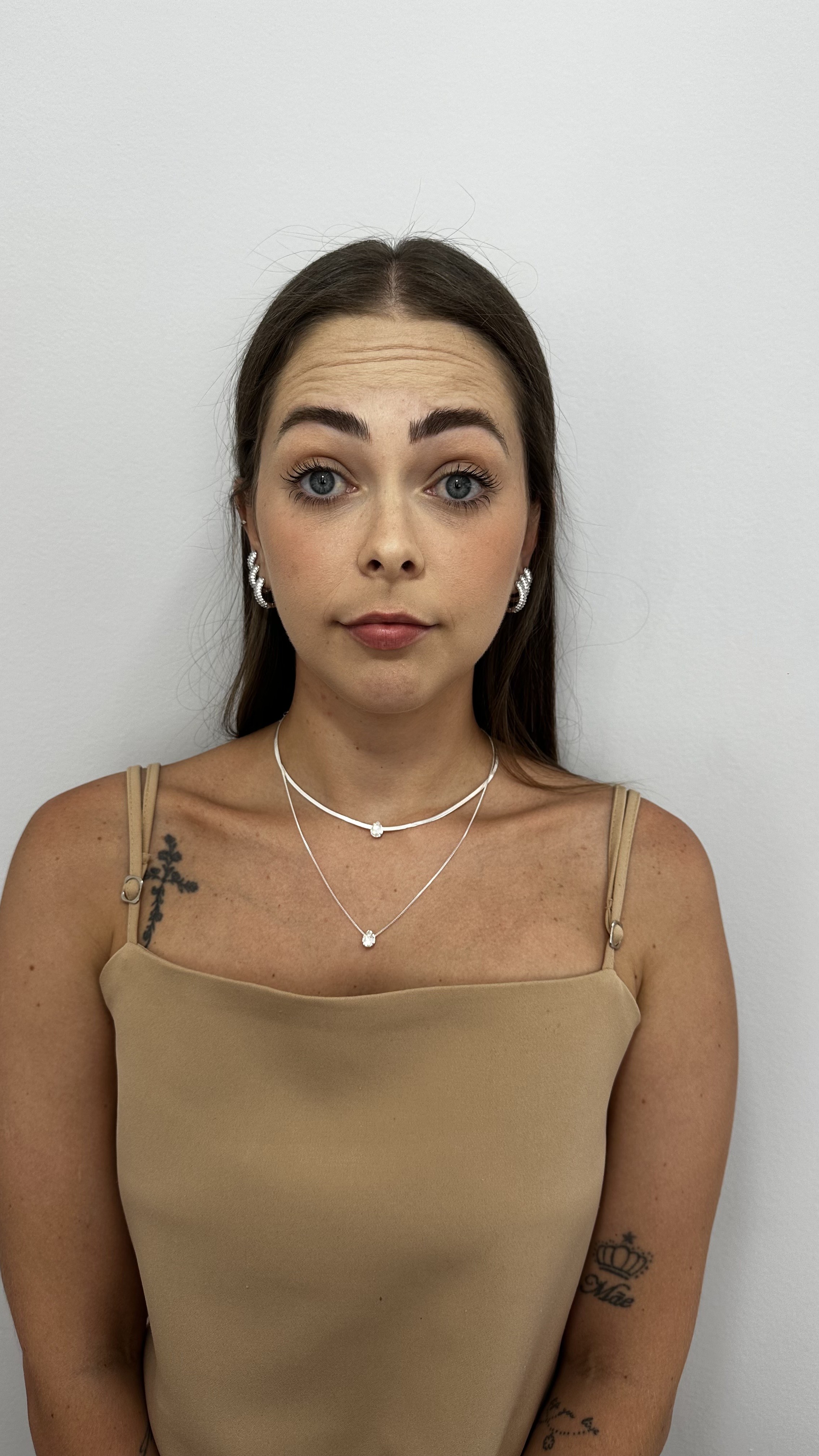 Antes - Toxina Botulínica